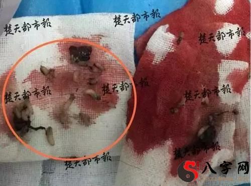 梦到从自己肉里拽出蛆